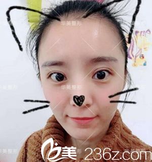 洛陽華美做全切雙眼皮案例 洛陽華美做全切雙眼皮案例