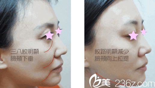 面部代表線雕提升效果