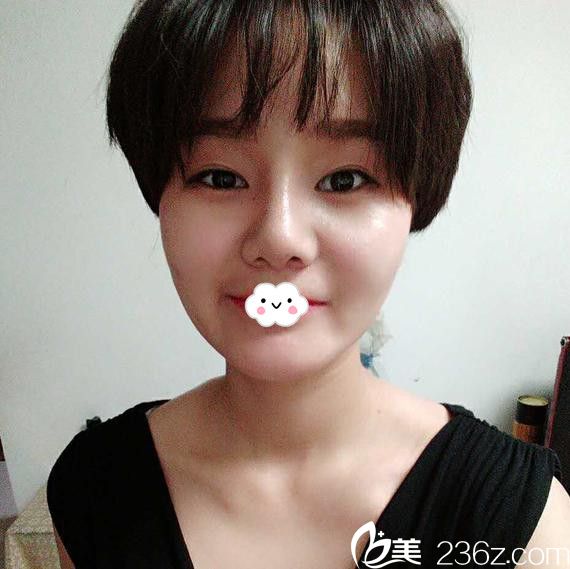 淮北微悅真人隆鼻效果好嗎？