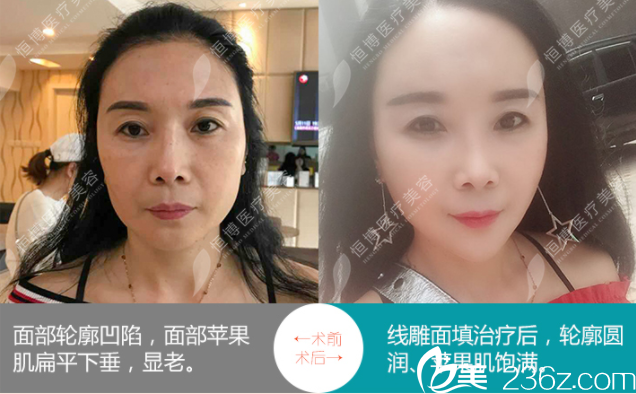 成都恒博線雕面填充治療案例 成都恒博線雕面填充治療案例