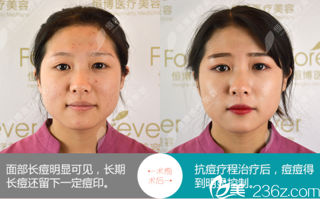 成都恒博去除痘痘 成都恒博去除痘痘
