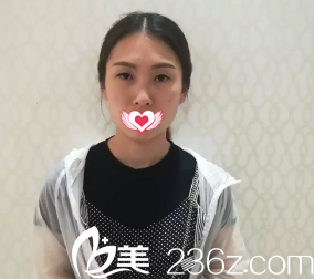 術(shù)前單眼皮 術(shù)前單眼皮