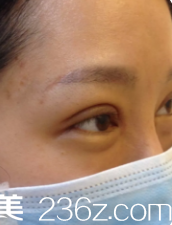 剛做完雙眼皮眼睛腫脹 剛做完雙眼皮眼睛腫脹