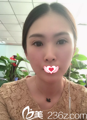 雙眼皮恢復(fù)16天完全消腫 雙眼皮恢復(fù)16天完全消腫