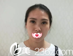 恢復(fù)7天后雙眼皮拆線后的樣子 恢復(fù)7天后雙眼皮拆線后的樣子