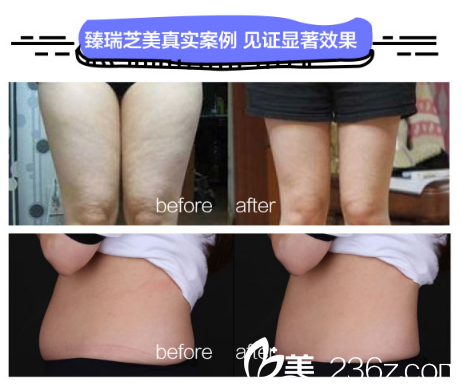 深圳臻瑞芝美醫(yī)療美容醫(yī)院酷塑冷凍溶脂案例圖