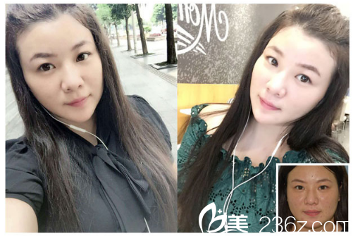 深圳臻瑞芝美整形醫(yī)院潘鐵軍面部線雕埋線提升案例圖
