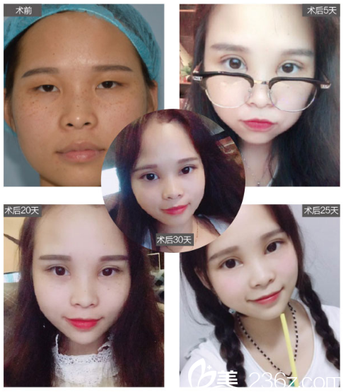 深圳臻瑞芝美整形醫(yī)院潘鐵軍雙眼皮案例效果圖