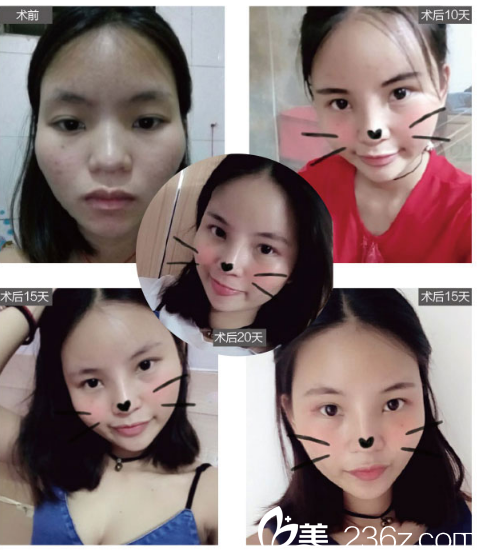 深圳臻瑞芝美整形醫(yī)院潘鐵軍自體脂肪面部填充案例圖