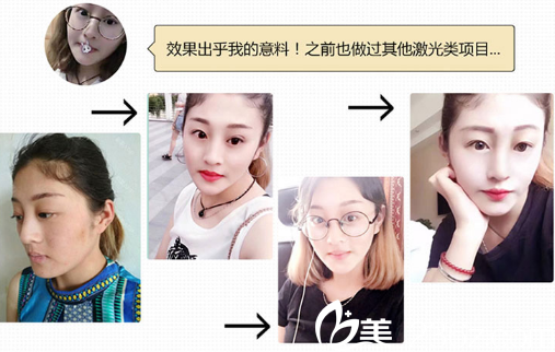 深圳臻瑞芝美醫(yī)療美容醫(yī)院披靡哦啊激光祛斑案例圖
