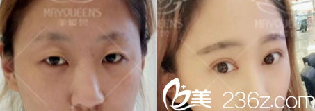 太原美媛薈整形雙眼皮效果圖 太原美媛薈整形雙眼皮效果圖