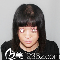 楊杰醫(yī)生給我做完頭發(fā)種植三個月 楊杰醫(yī)生給我做完頭發(fā)種植三個月