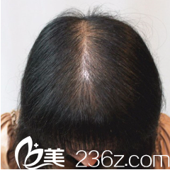 重慶時光整形頭發(fā)種植術(shù)后四個月 重慶時光整形頭發(fā)種植術(shù)后四個月
