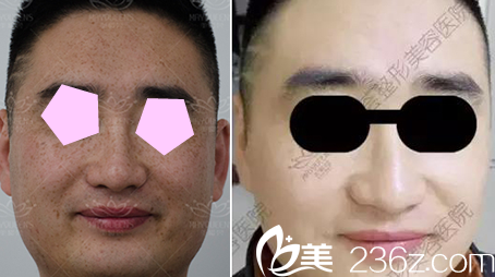 太原美媛薈面部激光祛斑前后效果對(duì)比圖 太原美媛薈面部激光祛斑前后效果對(duì)比圖