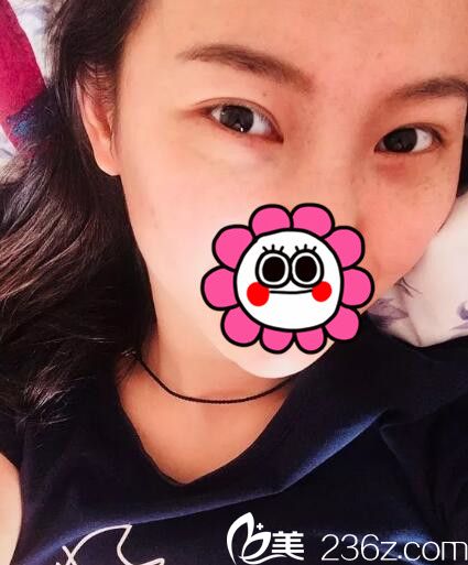 慶幸選擇專業(yè)正規(guī)的醫(yī)院做內(nèi)切去眼袋，術(shù)后半月就恢復(fù)了還沒有出現(xiàn)皮膚下垂