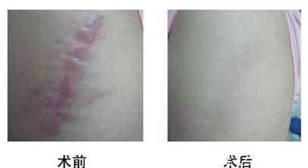 疤痕修復(fù)術(shù)前注意事項(xiàng) 疤痕修復(fù)術(shù)前注意事項(xiàng)
