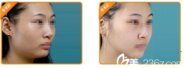 下頜角+顴骨內(nèi)推手術(shù)案例 下頜角+顴骨內(nèi)推手術(shù)案例