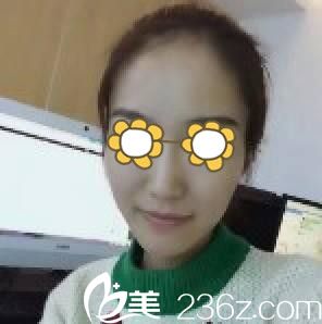 臉部自體脂肪填充前 臉部自體脂肪填充前