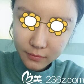 面部自體脂肪填充術(shù)后3天 面部自體脂肪填充術(shù)后3天