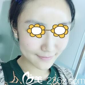 自體脂肪填充面部術(shù)后8天 自體脂肪填充面部術(shù)后8天