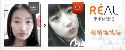 韓國麗兒整形醫(yī)院案例對比效果 韓國麗兒整形醫(yī)院案例對比效果