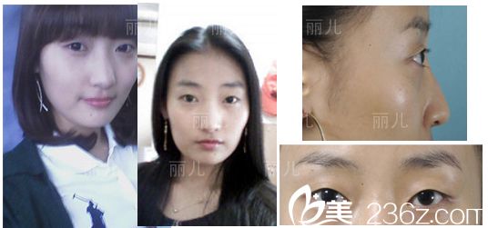 韓國麗兒整形隆鼻后3天 韓國麗兒整形隆鼻后3天
