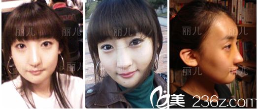 韓國麗兒整形醫(yī)院顴骨縮小案例 韓國麗兒整形醫(yī)院顴骨縮小案例