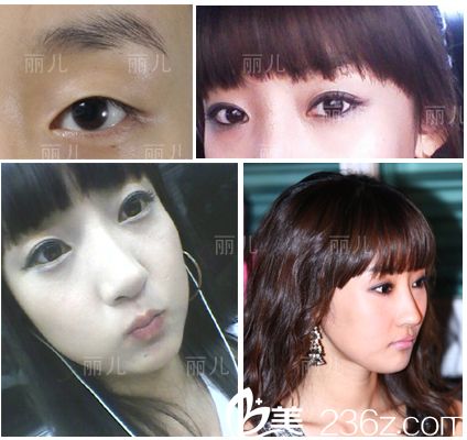 美女變形記：分享下我在韓國麗兒整形醫(yī)院找做雙眼皮+隆鼻+顴骨內(nèi)推后的變化過程