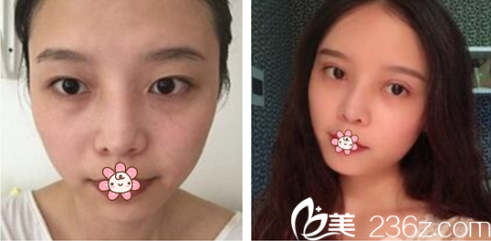 汪妍主任雙眼皮案例