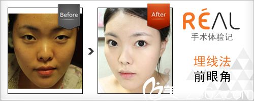 韓國(guó)麗兒整形醫(yī)院埋線雙眼皮手術(shù)真人案例 韓國(guó)麗兒整形醫(yī)院埋線雙眼皮手術(shù)真人案例