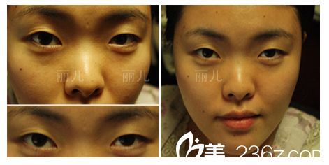 雙眼皮手術(shù)前照片 雙眼皮手術(shù)前照片