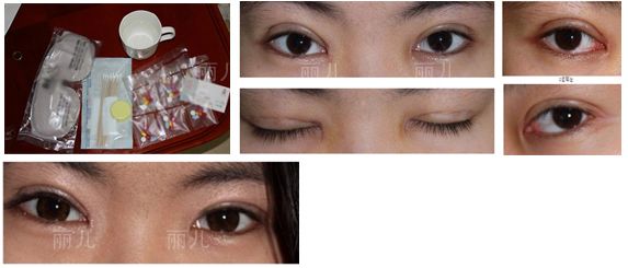 金壽信給我做雙眼皮手術(shù)一周了 金壽信給我做雙眼皮手術(shù)一周了