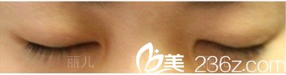 雙眼皮手術(shù)回復(fù)后閉眼效果 雙眼皮手術(shù)回復(fù)后閉眼效果