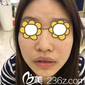 鼻綜合術(shù)前照 鼻綜合術(shù)前照