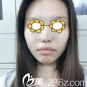 鼻綜合術(shù)后3天 鼻綜合術(shù)后3天