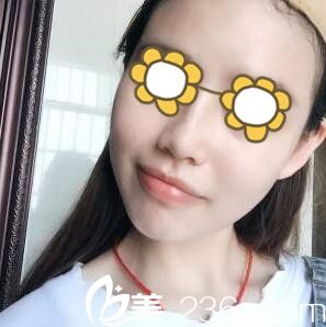 鼻綜合術(shù)后一周拆線 鼻綜合術(shù)后一周拆線