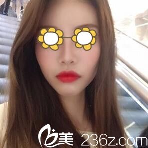 鼻綜合術(shù)后半個(gè)月 鼻綜合術(shù)后半個(gè)月