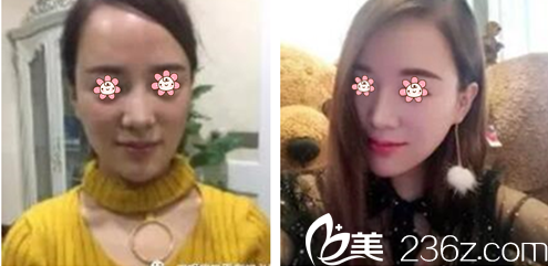 劉乃仁面部線雕案例