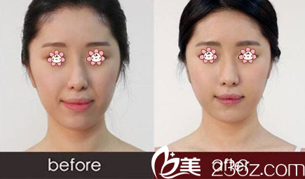 黃碩醫(yī)師玻尿酸填充法令紋案例 黃碩醫(yī)師玻尿酸填充法令紋案例