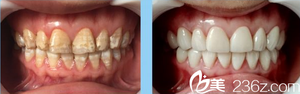 秦彪醫(yī)師牙齒貼面修復(fù)案例