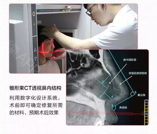 經(jīng)過數(shù)字化系統(tǒng)檢測鼻部填充的是奧美定