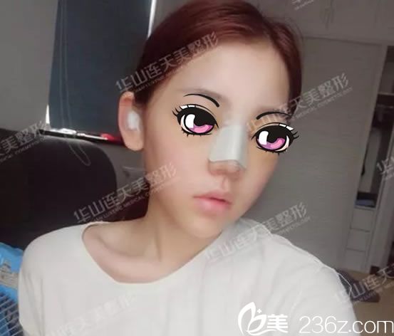 杭州連天美<!--<i data=20240703-sp></i>-->鼻修復(fù)3天效果