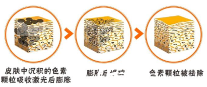 濟(jì)源<!--<i data=20240703-sp></i>-->萍激光祛斑的方法 濟(jì)源<!--<i data=20240703-sp></i>-->萍激光祛斑的方法