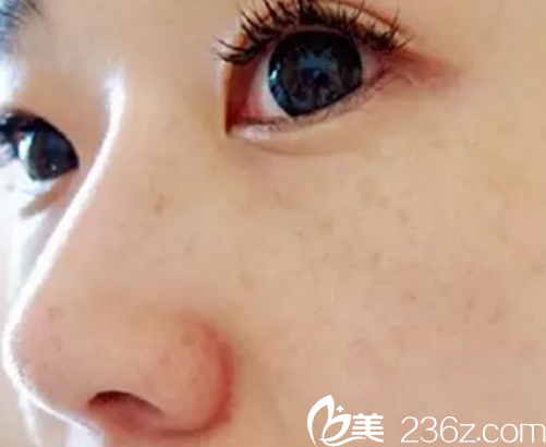 濟(jì)源<!--<i data=20240703-sp></i>-->萍激光祛斑整形案例手術(shù)前 濟(jì)源<!--<i data=20240703-sp></i>-->萍激光祛斑整形案例手術(shù)前