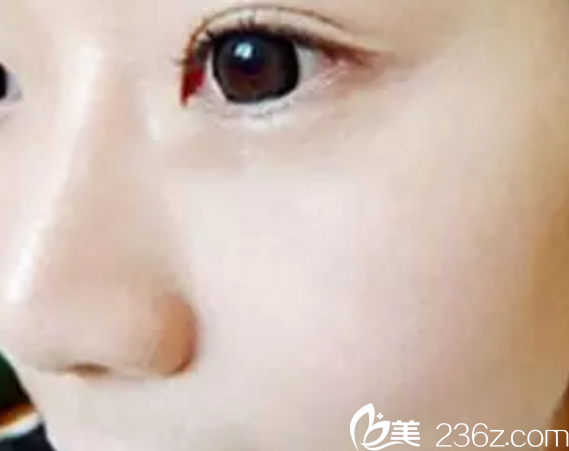  術(shù)后20天從無(wú)鹽女變女神，分享我在濟(jì)源萍做激光祛斑術(shù)手術(shù)效果