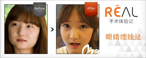 韓國麗兒整形醫(yī)院雙眼皮手術(shù)案例 韓國麗兒整形醫(yī)院雙眼皮手術(shù)案例