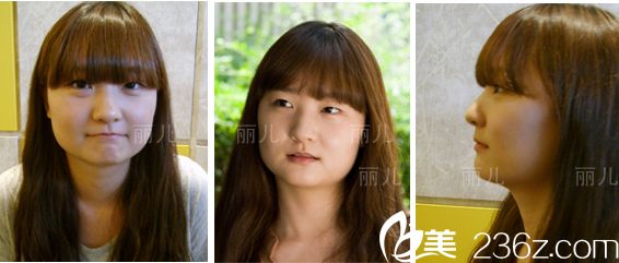 金壽信下頜角手術(shù)案例 金壽信下頜角手術(shù)案例