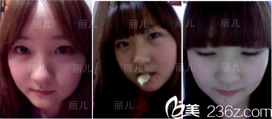 術(shù)后三周后效果 術(shù)后三周后效果