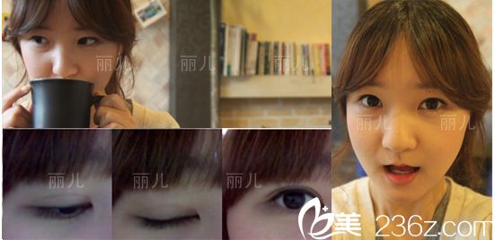 下頜角手術(shù)一個(gè)月后效果 下頜角手術(shù)一個(gè)月后效果