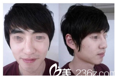 術(shù)前歪鼻子鷹鉤鼻 術(shù)前歪鼻子鷹鉤鼻